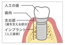 インプラントとは？